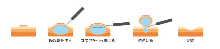 内視鏡的粘膜切除術