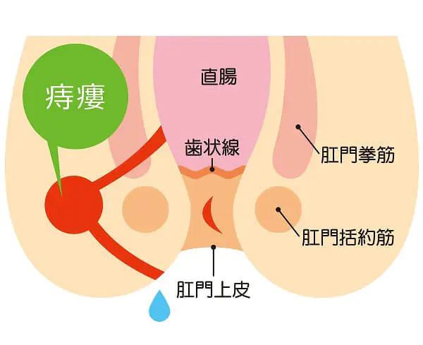 痔瘻