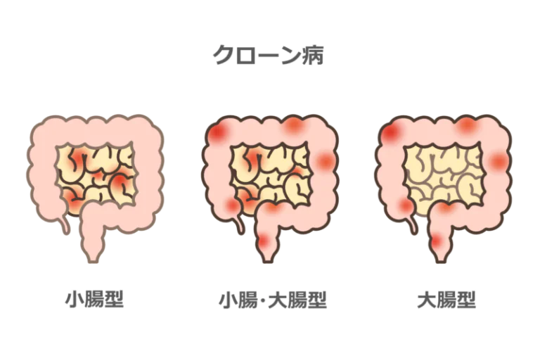 クローン病